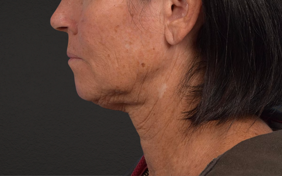 Neck Lift Before & After Gallery - Patient 540880 - Image 5