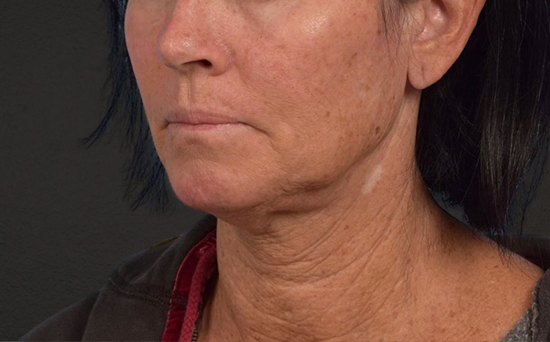 Neck Lift Before & After Gallery - Patient 540880 - Image 3