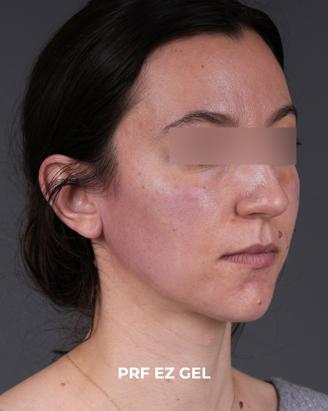 PRF Before & After Gallery - Patient 856119 - Image 4
