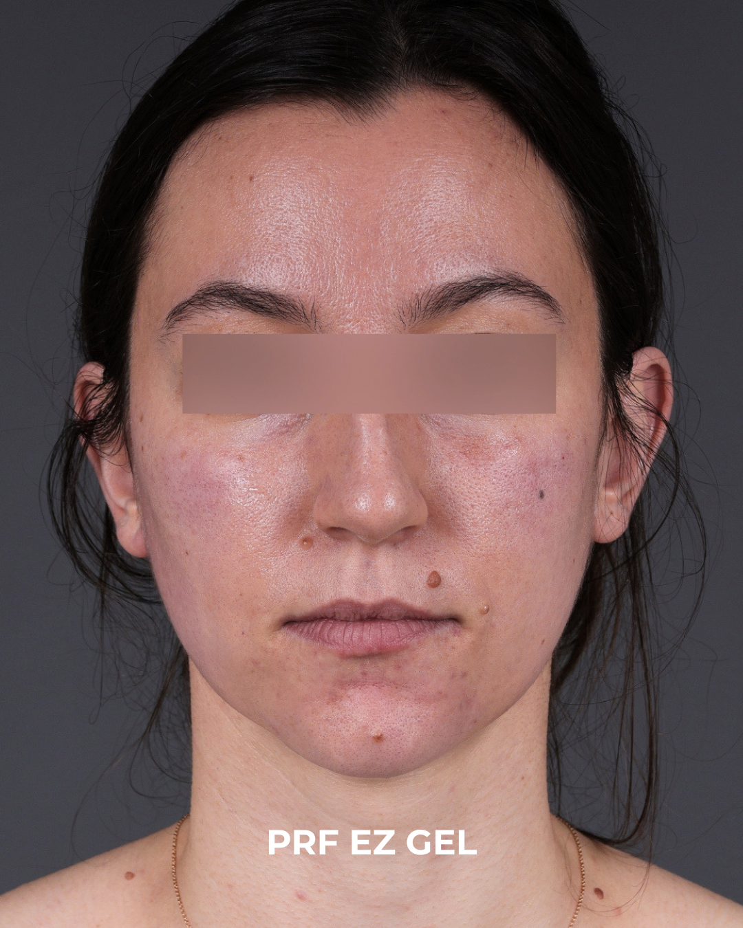 PRF Before & After Gallery - Patient 856119 - Image 2