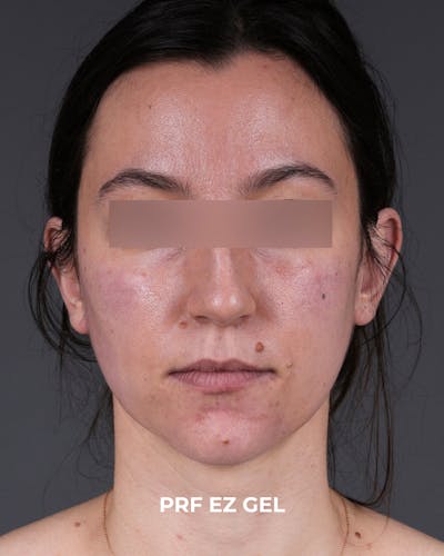 PRF Before & After Gallery - Patient 856119 - Image 2