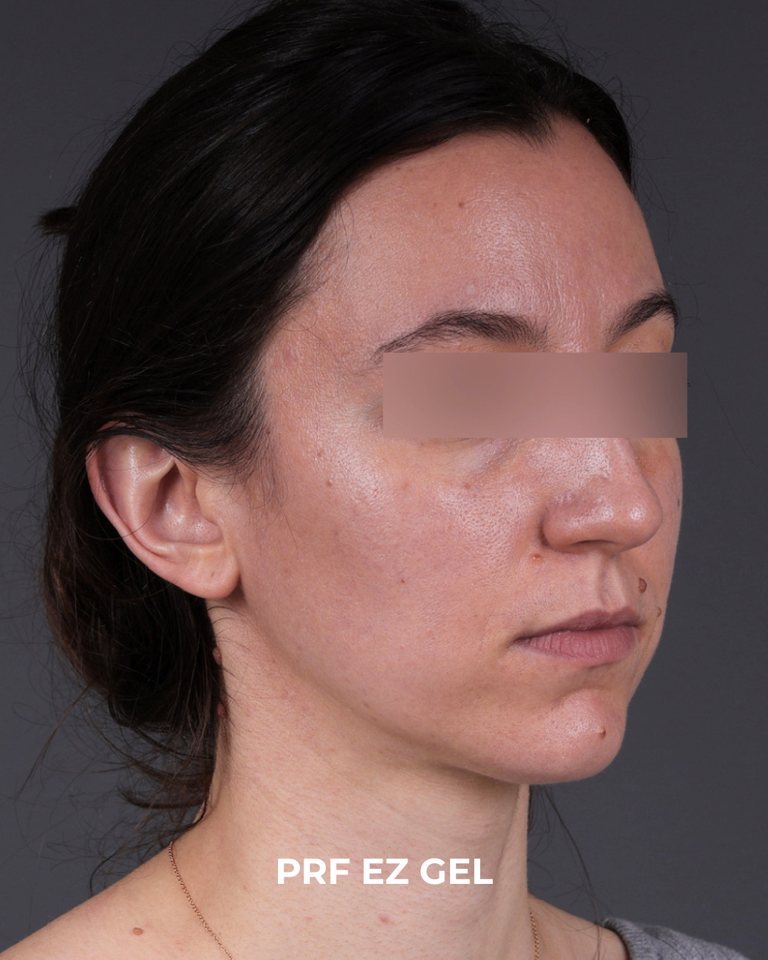 PRF Before & After Gallery - Patient 856119 - Image 3