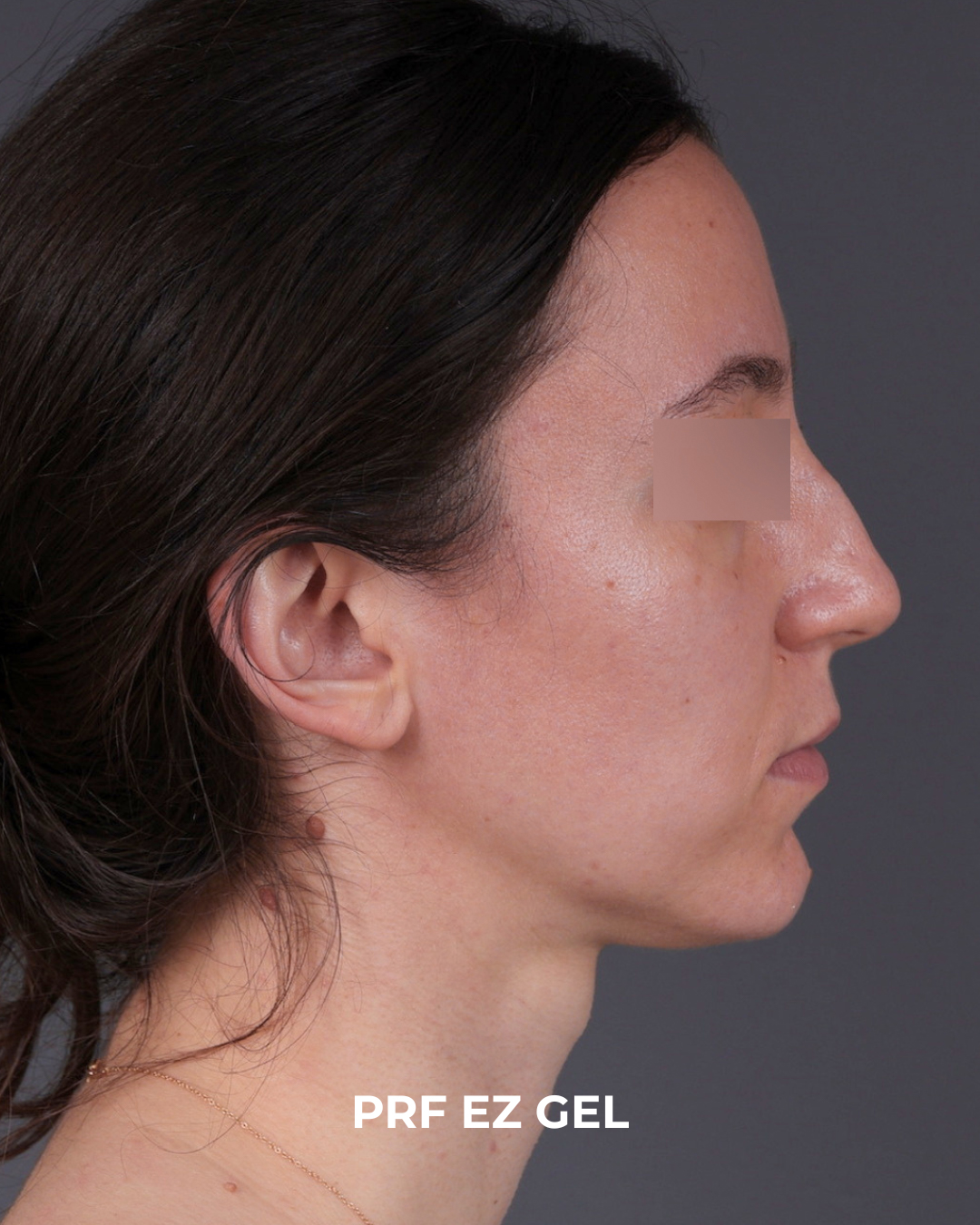 PRF Before & After Gallery - Patient 856119 - Image 5