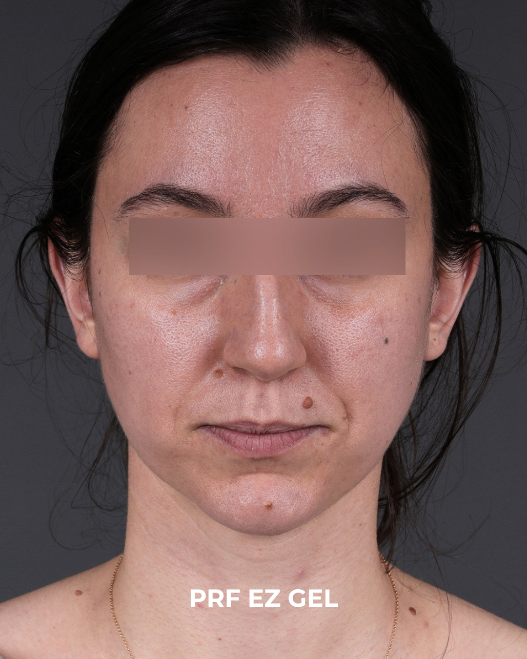 PRF Before & After Gallery - Patient 856119 - Image 1