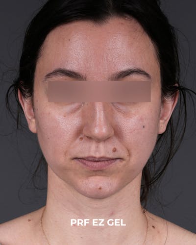 PRF Before & After Gallery - Patient 856119 - Image 1