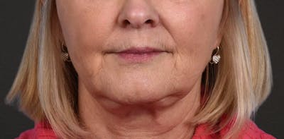 Neck Lift Before & After Gallery - Patient 350287 - Image 2