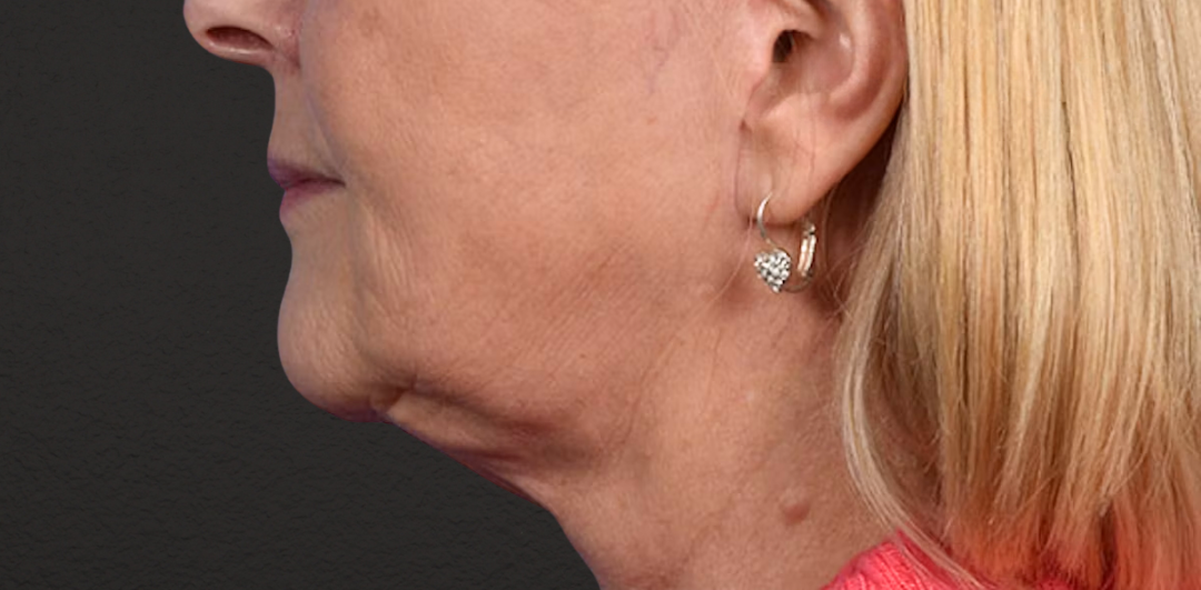Neck Lift Before & After Gallery - Patient 350287 - Image 6