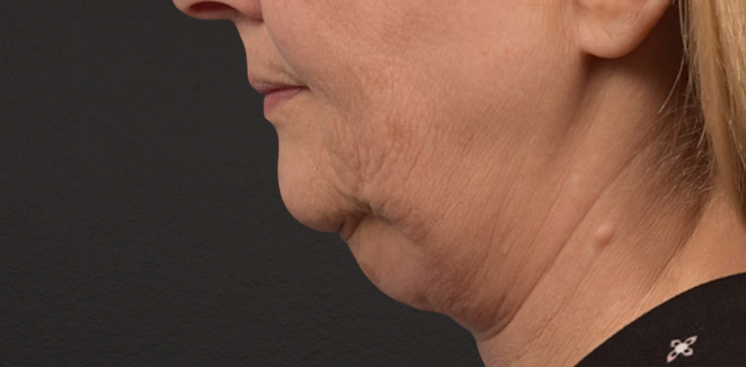 Neck Lift Before & After Gallery - Patient 350287 - Image 5