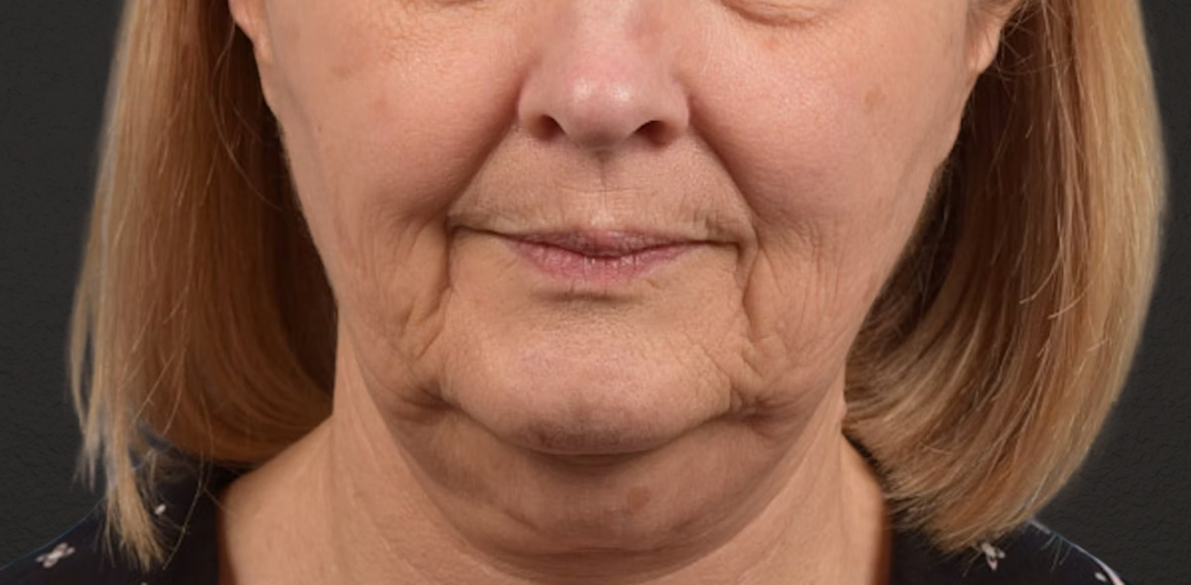 Neck Lift Before & After Gallery - Patient 350287 - Image 1