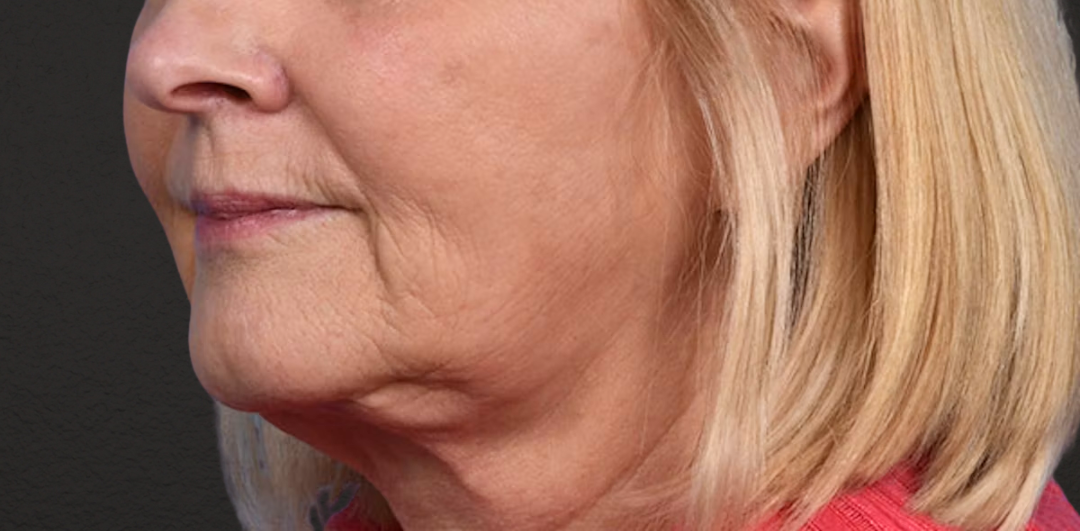 Neck Lift Before & After Gallery - Patient 350287 - Image 4