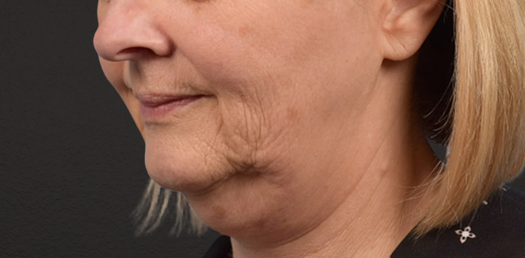Neck Lift Before & After Gallery - Patient 350287 - Image 3