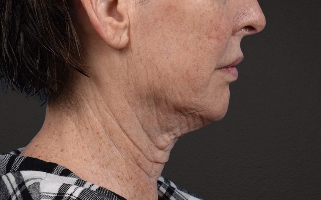 Neck Lift Before & After Gallery - Patient 238925 - Image 5