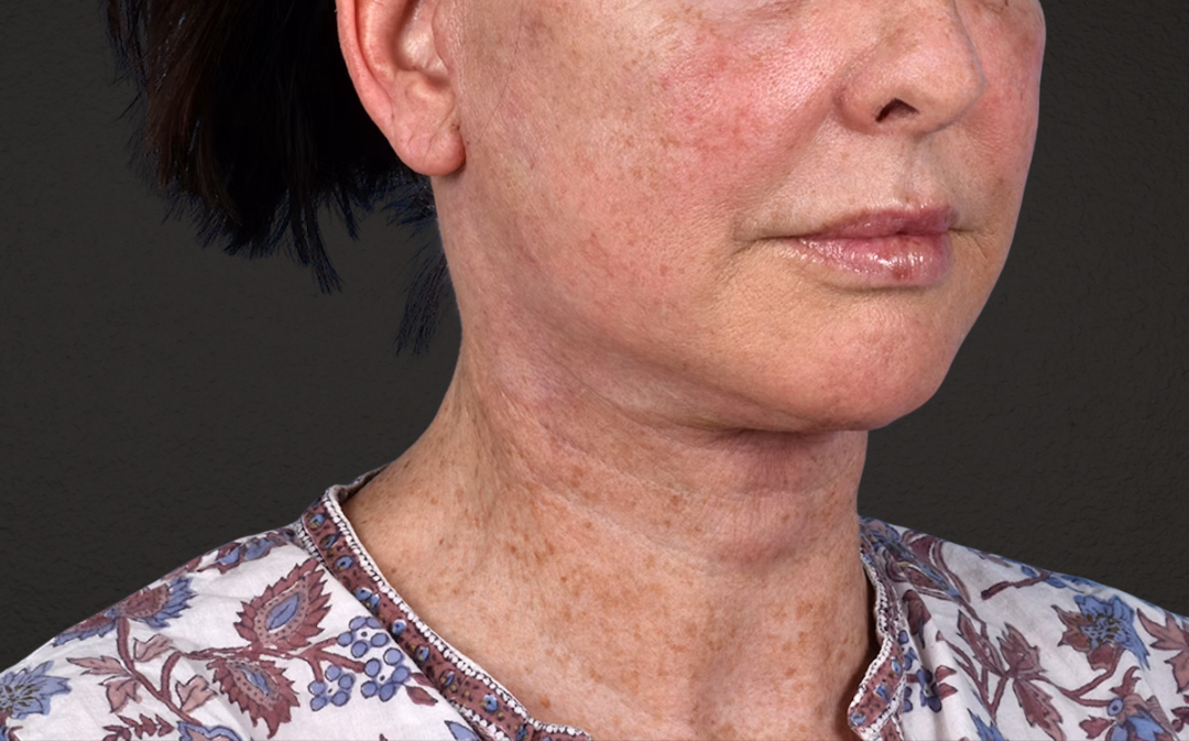 Neck Lift Before & After Gallery - Patient 238925 - Image 4