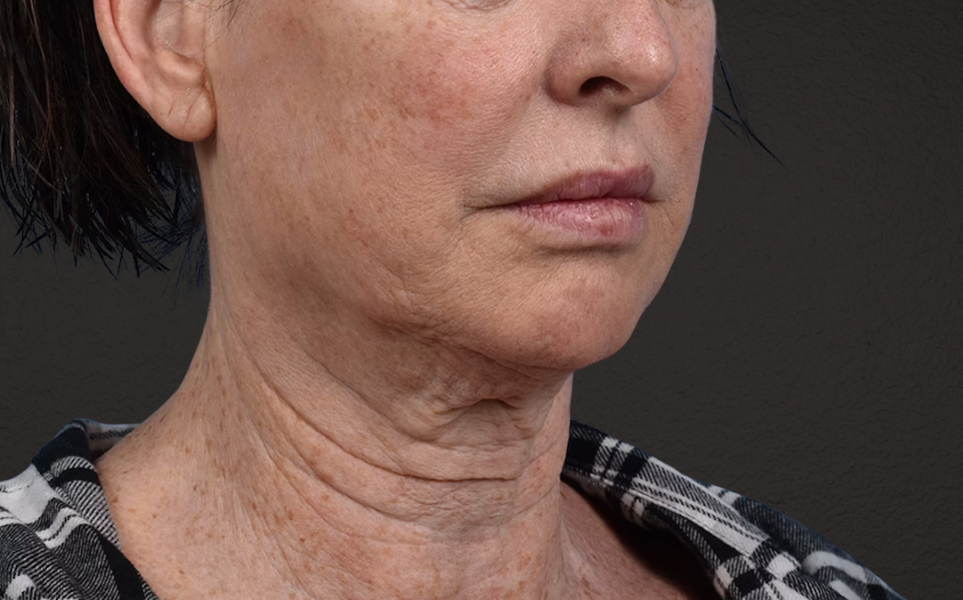 Neck Lift Before & After Gallery - Patient 238925 - Image 3