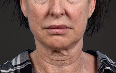 Neck Lift Before & After Gallery - Patient 238925 - Image 1