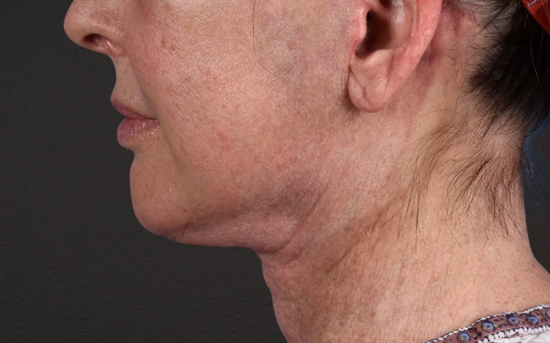 Neck Lift Before & After Gallery - Patient 238925 - Image 10