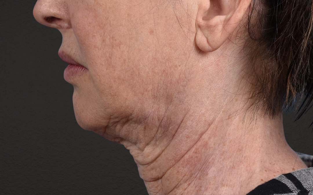Neck Lift Before & After Gallery - Patient 238925 - Image 9