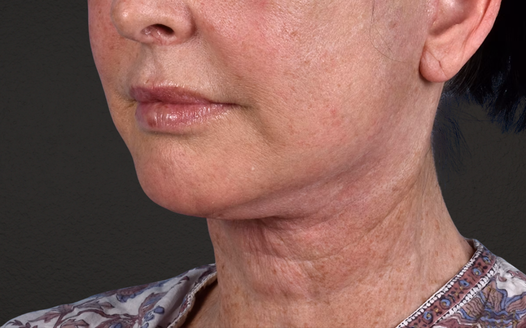 Neck Lift Before & After Gallery - Patient 238925 - Image 8