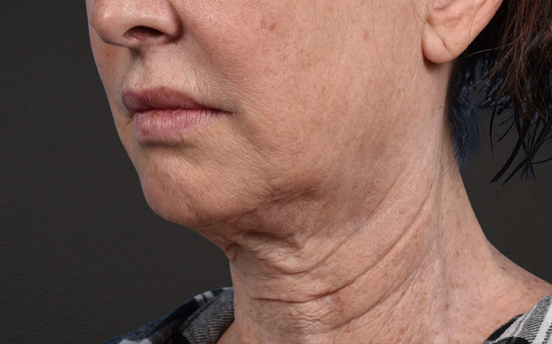Neck Lift Before & After Gallery - Patient 238925 - Image 7
