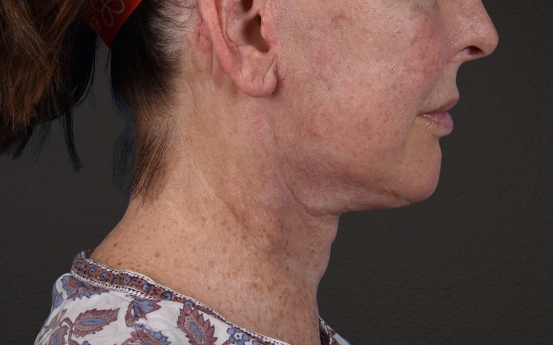 Neck Lift Before & After Gallery - Patient 238925 - Image 6