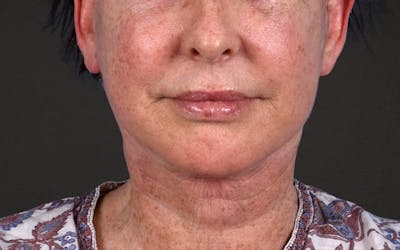 Neck Lift Before & After Gallery - Patient 238925 - Image 2