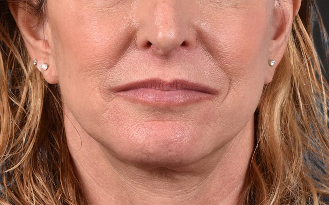 Neck Lift Before & After Gallery - Patient 522152 - Image 2