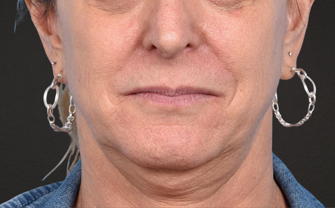 Neck Lift Before & After Gallery - Patient 522152 - Image 1