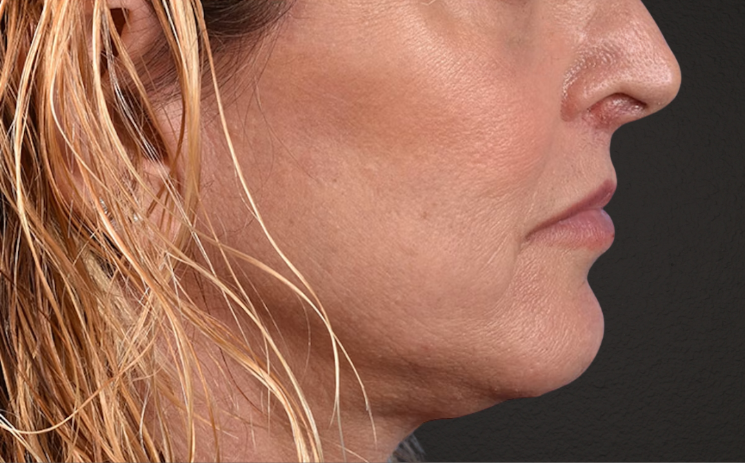 Neck Lift Before & After Gallery - Patient 522152 - Image 6