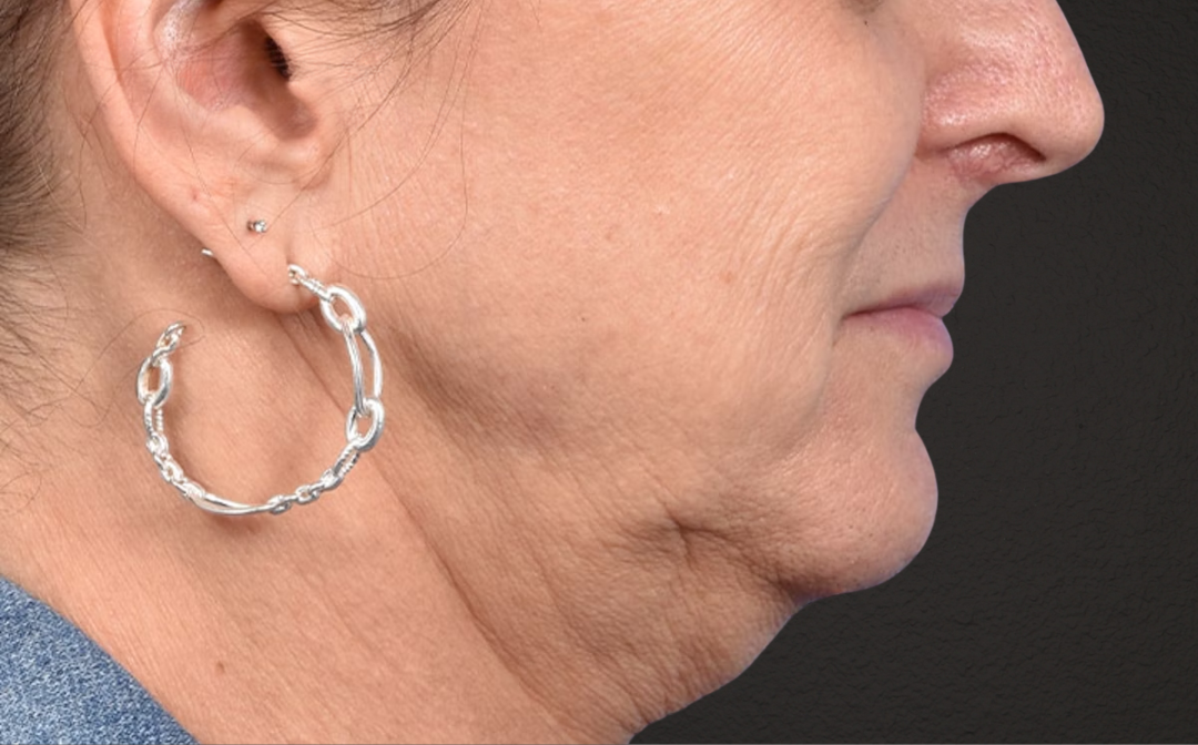 Neck Lift Before & After Gallery - Patient 522152 - Image 5