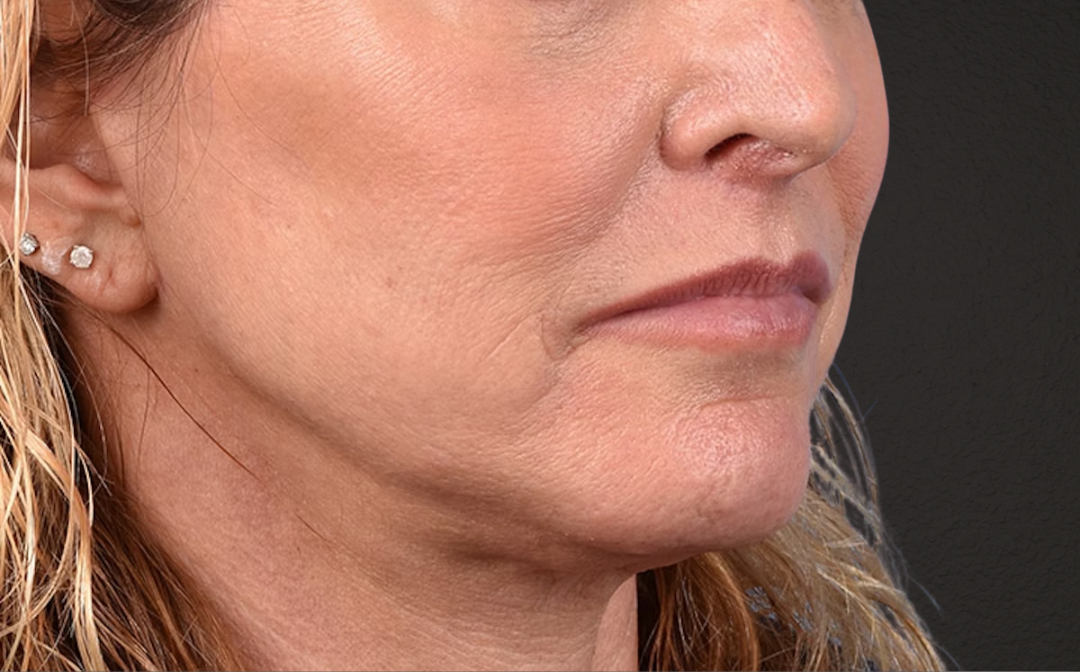 Neck Lift Before & After Gallery - Patient 522152 - Image 4