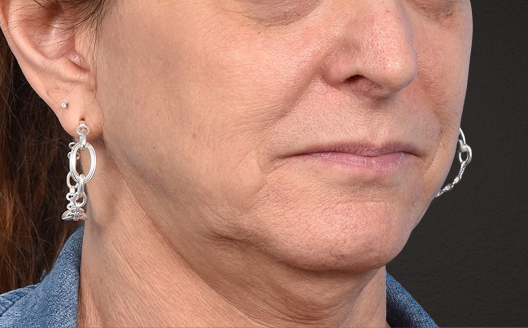 Neck Lift Before & After Gallery - Patient 522152 - Image 3