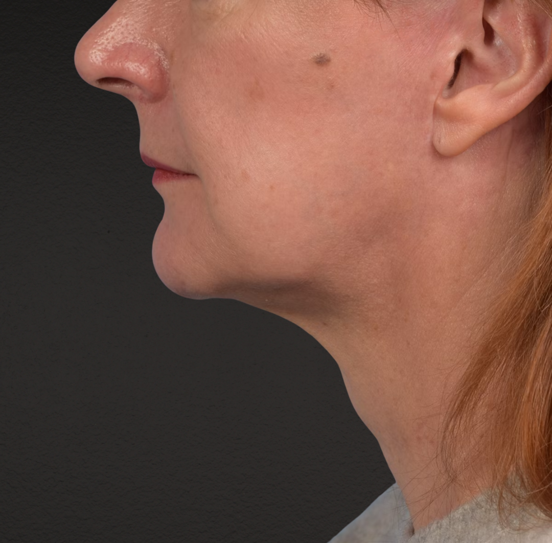 Neck Lift Before & After Gallery - Patient 204140 - Image 10