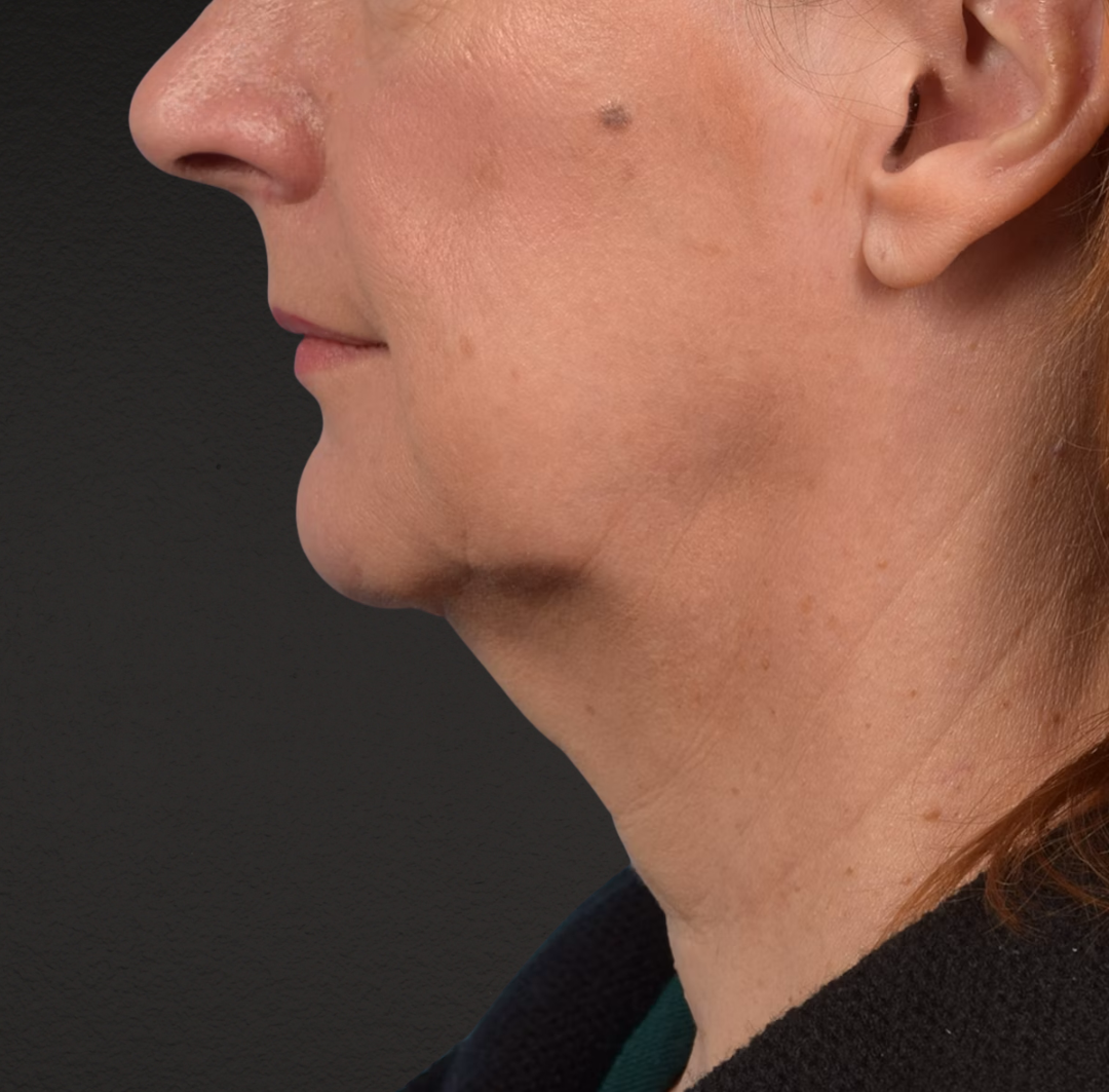 Neck Lift Before & After Gallery - Patient 204140 - Image 9