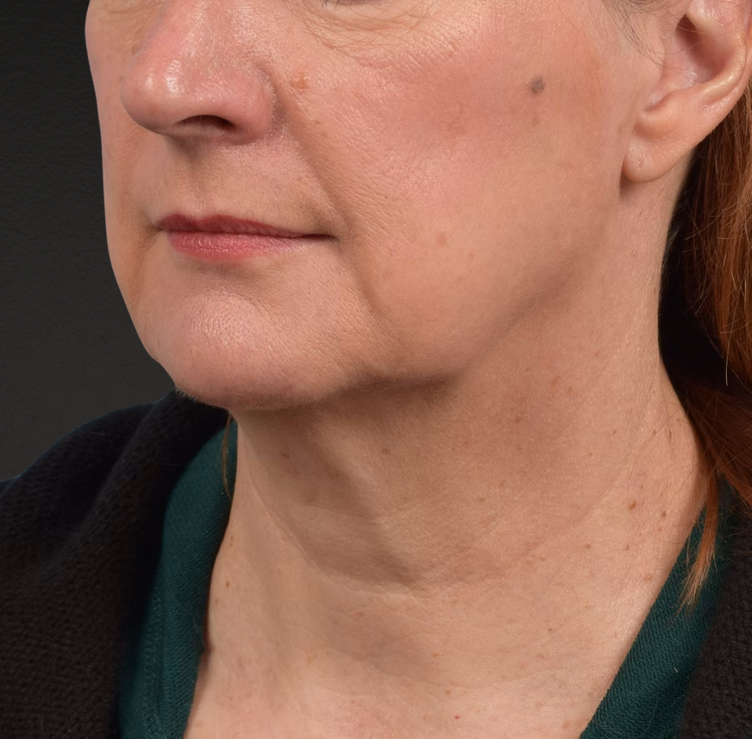 Neck Lift Before & After Gallery - Patient 204140 - Image 7