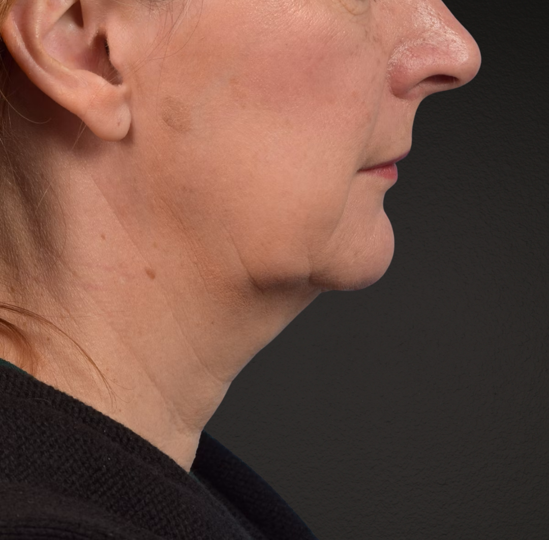 Neck Lift Before & After Gallery - Patient 204140 - Image 5