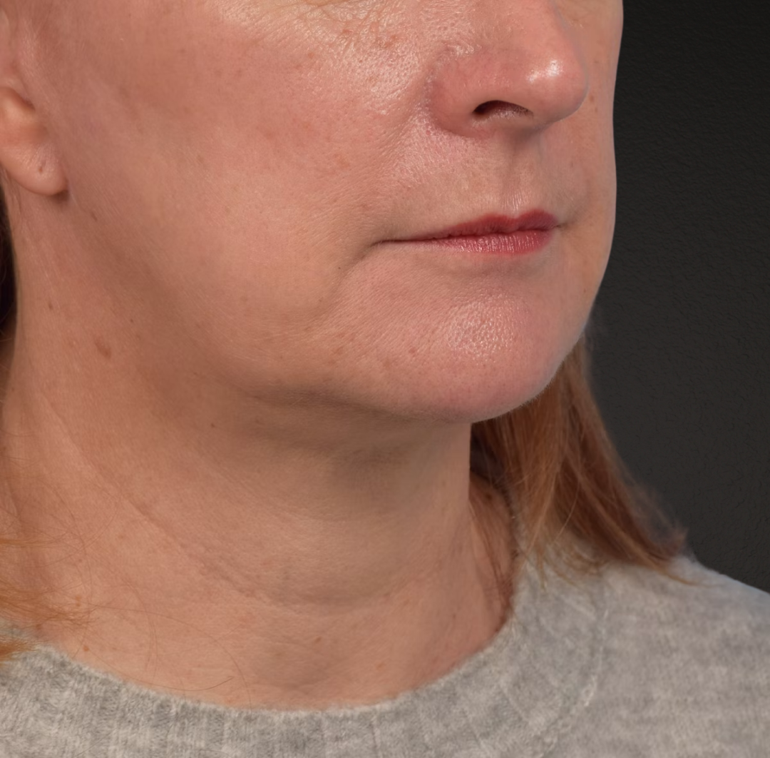 Neck Lift Before & After Gallery - Patient 204140 - Image 4