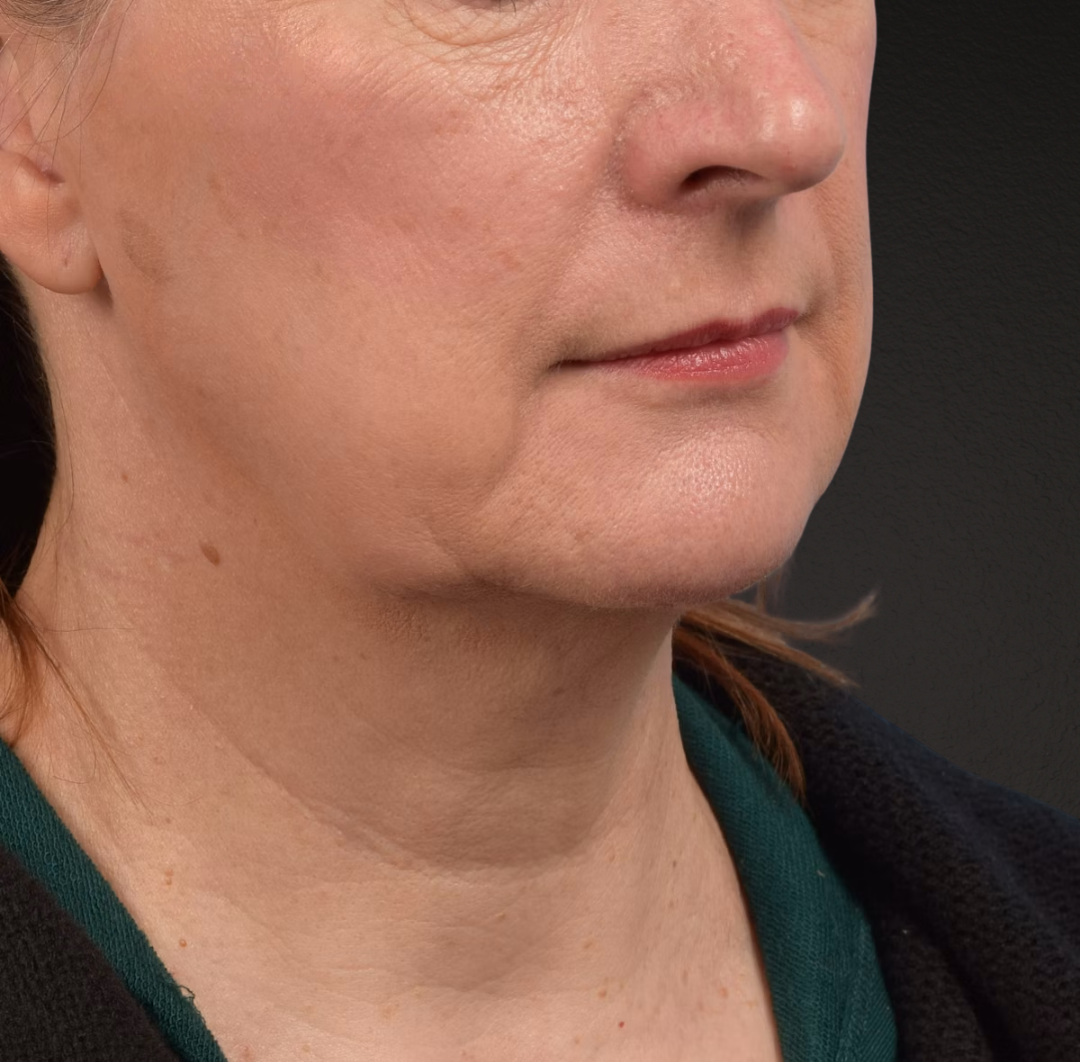Neck Lift Before & After Gallery - Patient 204140 - Image 3