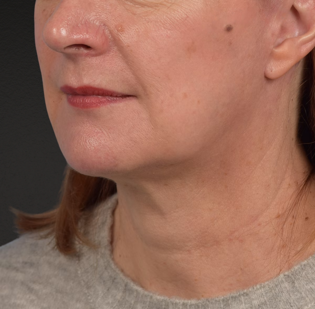 Neck Lift Before & After Gallery - Patient 204140 - Image 8