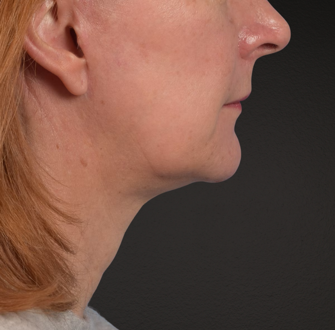 Neck Lift Before & After Gallery - Patient 204140 - Image 6