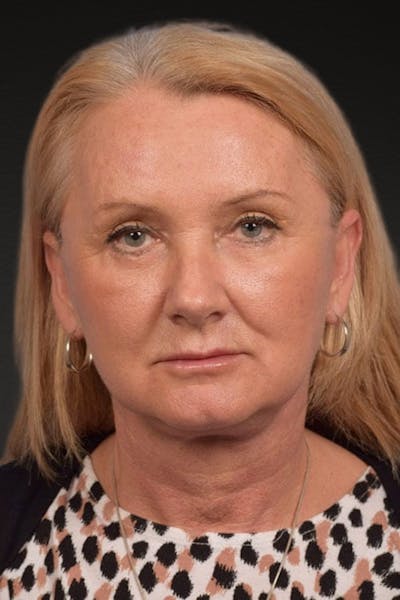 Neck Lift Before & After Gallery - Patient 207141 - Image 2