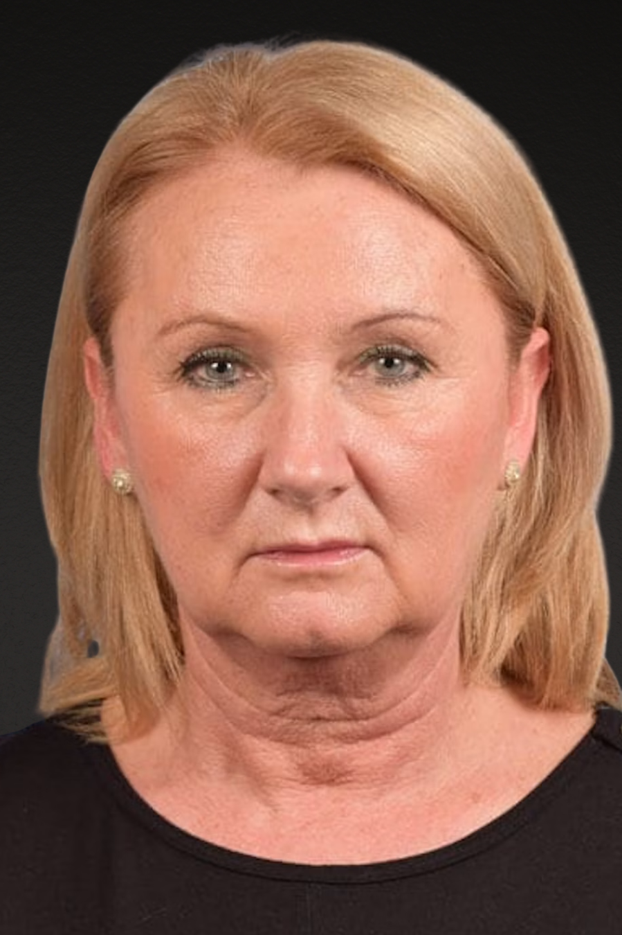 Neck Lift Before & After Gallery - Patient 207141 - Image 1