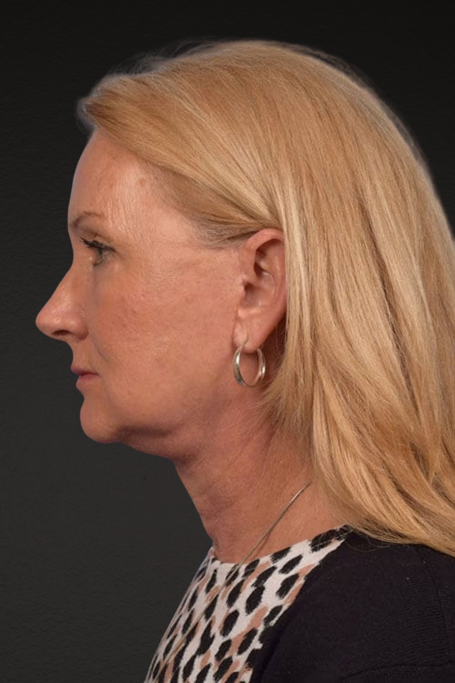 Neck Lift Before & After Gallery - Patient 207141 - Image 6