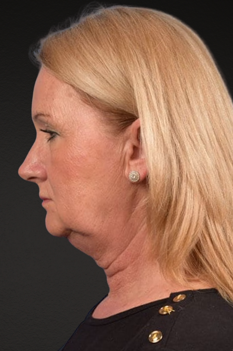 Neck Lift Before & After Gallery - Patient 207141 - Image 5