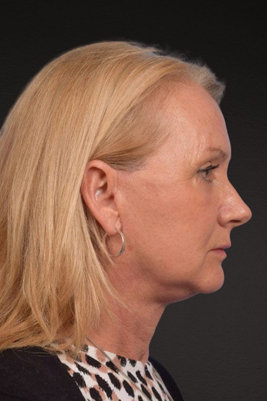 Neck Lift Before & After Gallery - Patient 207141 - Image 4