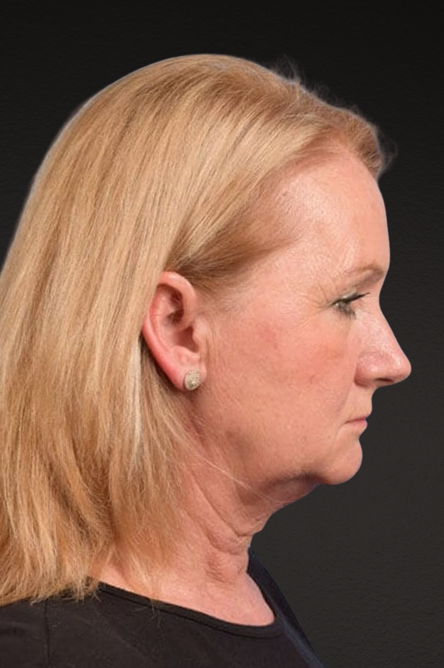 Neck Lift Before & After Gallery - Patient 207141 - Image 3