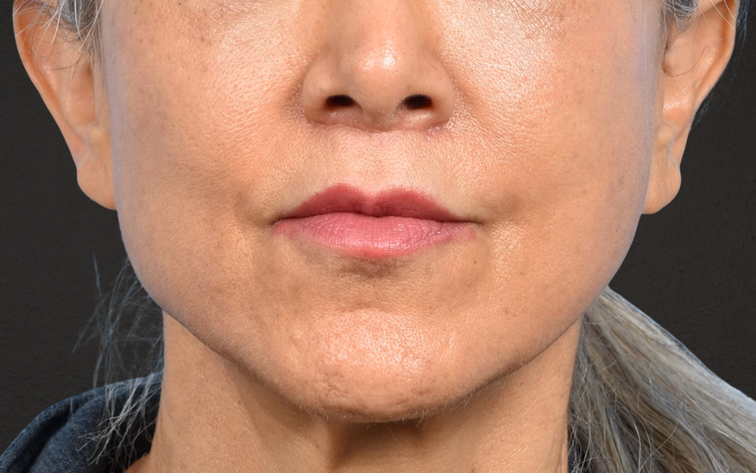 Lip Lift Before & After Gallery - Patient 376152 - Image 2