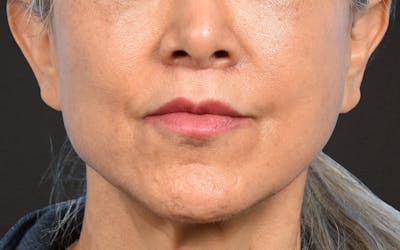 Lip Lift Before & After Gallery - Patient 376152 - Image 2