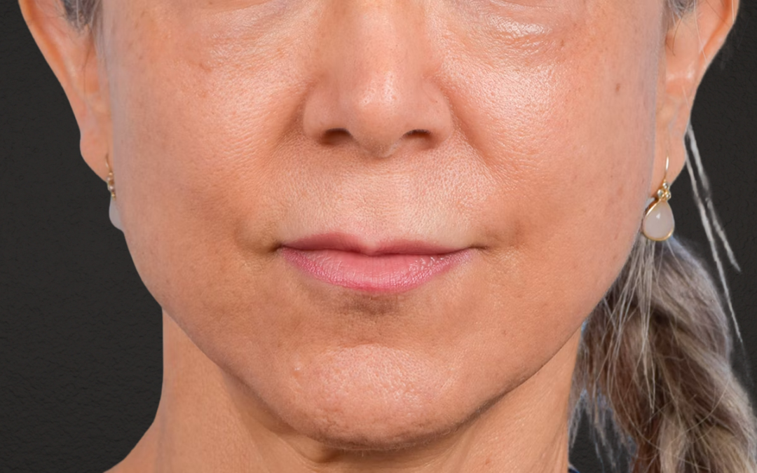 Lip Lift Before & After Gallery - Patient 376152 - Image 1