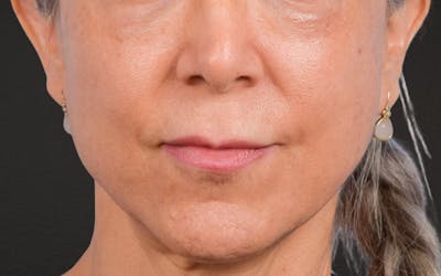 Lip Lift Before & After Gallery - Patient 376152 - Image 1