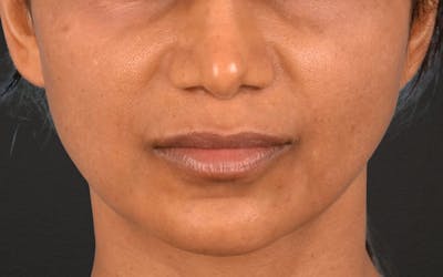Lip Lift Before & After Gallery - Patient 369454 - Image 1